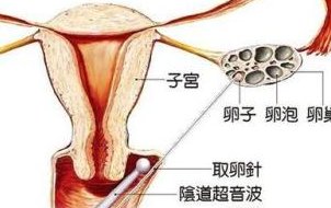 江西试管婴儿医院能否预防唐氏综合症？